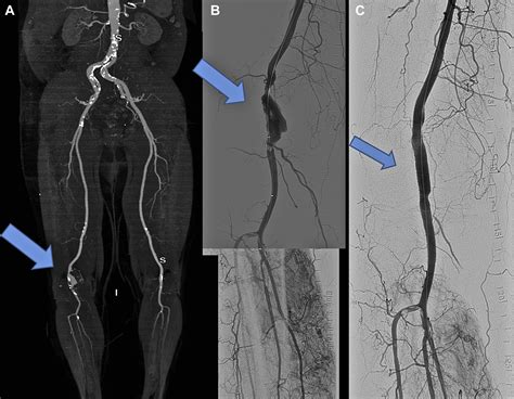 popliteal artery stenosis